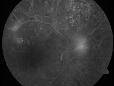 PDR - Mild Vitreous Hemorrhage and Good Vision
58-year-old woman has diabetic retinopathy in both eyes with neovascularization of the optic nerve, worse in the right eye than the left eye.  She has had panretinal laser in both eyes and vitreous hemorrhage in the left eye.  Her vision, since I saw her last in June, is about the same.  

VISUAL ACUITY:  Vision OD is 20/25, OS is 20/20. 
