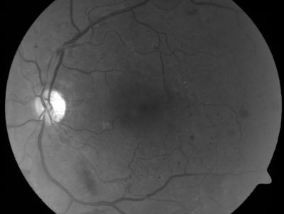 PDR - Mild Vitreous Hemorrhage and Good Vision
58-year-old woman has diabetic retinopathy in both eyes with neovascularization of the optic nerve, worse in the right eye than the left eye.  She has had panretinal laser in both eyes and vitreous hemorrhage in the left eye.  Her vision, since I saw her last in June, is about the same.  

VISUAL ACUITY:  Vision OD is 20/25, OS is 20/20. 
