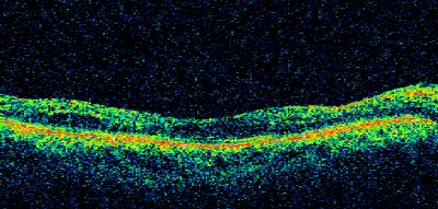 PDR
58-year-old woman has diabetic retinopathy in both eyes with neovascularization of the optic nerve, worse in the right eye than the left eye.  She has had panretinal laser in both eyes and vitreous hemorrhage in the left eye.  Her vision, since I saw her last in June, is about the same.  

VISUAL ACUITY:  Vision OD is 20/25, OS is 20/20. 
