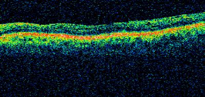 PDR
58-year-old woman has diabetic retinopathy in both eyes with neovascularization of the optic nerve, worse in the right eye than the left eye.  She has had panretinal laser in both eyes and vitreous hemorrhage in the left eye.  Her vision, since I saw her last in June, is about the same.  

VISUAL ACUITY:  Vision OD is 20/25, OS is 20/20. 

