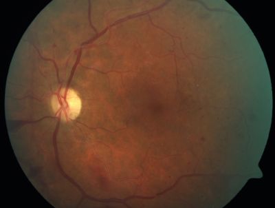 PDR - Mild Vitreous Hemorrhage and Good Vision
58-year-old woman has diabetic retinopathy in both eyes with neovascularization of the optic nerve, worse in the right eye than the left eye.  She has had panretinal laser in both eyes and vitreous hemorrhage in the left eye.  Her vision, since I saw her last in June, is about the same.  

VISUAL ACUITY:  Vision OD is 20/25, OS is 20/20. 
