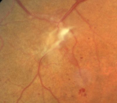 PDR - Preretinal Fibrosis
58-year-old woman has diabetic retinopathy in both eyes with neovascularization of the optic nerve, worse in the right eye than the left eye.  She has had panretinal laser in both eyes and vitreous hemorrhage in the left eye.  Her vision, since I saw her last in June, is about the same.  

VISUAL ACUITY:  Vision OD is 20/25, OS is 20/20. 
