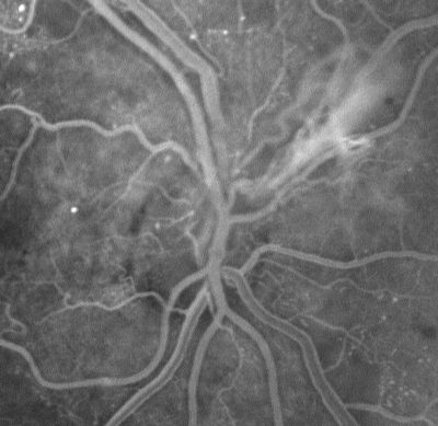 PDR - Mild Vitreous Hemorrhage and Good Vision
58-year-old woman has diabetic retinopathy in both eyes with neovascularization of the optic nerve, worse in the right eye than the left eye.  She has had panretinal laser in both eyes and vitreous hemorrhage in the left eye.  Her vision, since I saw her last in June, is about the same.  

VISUAL ACUITY:  Vision OD is 20/25, OS is 20/20. 
