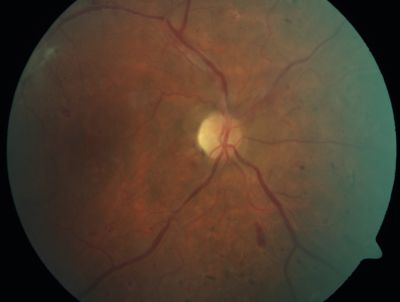 PDR - Mild Vitreous Hemorrhage and Good Vision
58-year-old woman has diabetic retinopathy in both eyes with neovascularization of the optic nerve, worse in the right eye than the left eye.  She has had panretinal laser in both eyes and vitreous hemorrhage in the left eye.  Her vision, since I saw her last in June, is about the same.  

VISUAL ACUITY:  Vision OD is 20/25, OS is 20/20. 

