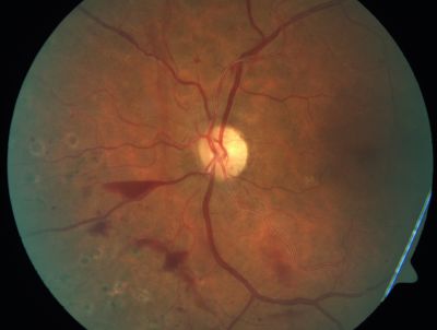 PDR - Mild Vitreous Hemorrhage and Good Vision
58-year-old woman has diabetic retinopathy in both eyes with neovascularization of the optic nerve, worse in the right eye than the left eye.  She has had panretinal laser in both eyes and vitreous hemorrhage in the left eye.  Her vision, since I saw her last in June, is about the same.  

VISUAL ACUITY:  Vision OD is 20/25, OS is 20/20. 
