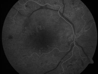 PDR - Mild Vitreous Hemorrhage and Good Vision
58-year-old woman has diabetic retinopathy in both eyes with neovascularization of the optic nerve, worse in the right eye than the left eye.  She has had panretinal laser in both eyes and vitreous hemorrhage in the left eye.  Her vision, since I saw her last in June, is about the same.  

VISUAL ACUITY:  Vision OD is 20/25, OS is 20/20. 
