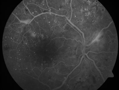 PDR - Mild Vitreous Hemorrhage and Good Vision
58-year-old woman has diabetic retinopathy in both eyes with neovascularization of the optic nerve, worse in the right eye than the left eye.  She has had panretinal laser in both eyes and vitreous hemorrhage in the left eye.  Her vision, since I saw her last in June, is about the same.  

VISUAL ACUITY:  Vision OD is 20/25, OS is 20/20. 
