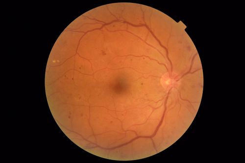 Moderate PDR
43 year old man 20/32 vision in both eyes.  Being started on Anti-VEGF injections which will be followed by PRP.
