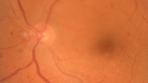 Moderate PDR
43 year old man 20/32 vision in both eyes.  Being started on Anti-VEGF injections which will be followed by PRP.
