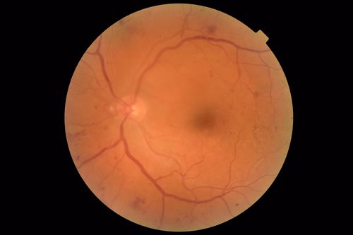 Moderate PDR
43 year old man 20/32 vision in both eyes.  Being started on Anti-VEGF injections which will be followed by PRP.
