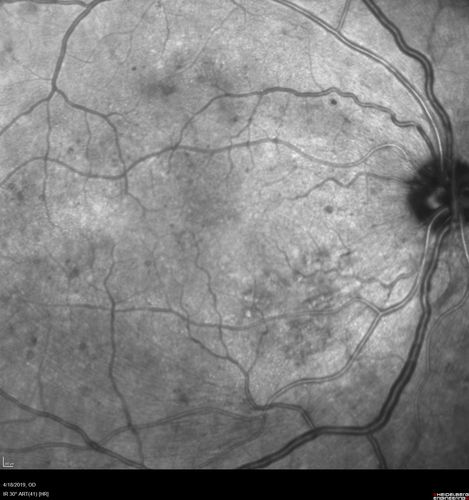 Moderate PDR
43 year old man 20/32 vision in both eyes.  Being started on Anti-VEGF injections which will be followed by PRP.

