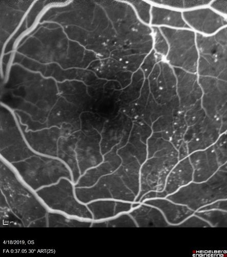 Moderate PDR
43 year old man 20/32 vision in both eyes.  Being started on Anti-VEGF injections which will be followed by PRP.
