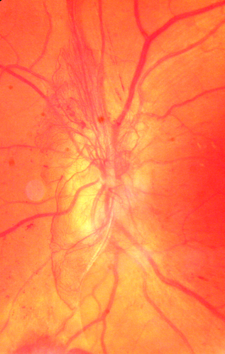 PDR NVD left eye and NVE right eye
41 year old diabetic woman with PDR in both eyes.  High risk in the left eye.  She had PRP, Avastin, and vitrectomy x 2 in the left eye with final vision of 20/25.  The right eye had eventually PRP laser

