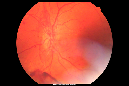 PDR NVD left eye and NVE right eye
41 year old diabetic woman with PDR in both eyes.  High risk in the left eye.  She had PRP, Avastin, and vitrectomy x 2 in the left eye with final vision of 20/25.  The right eye had eventually PRP laser
