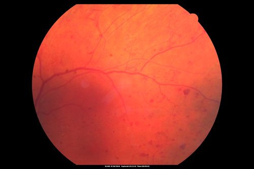 PDR NVD left eye and NVE right eye
41 year old diabetic woman with PDR in both eyes.  High risk in the left eye.  She had PRP, Avastin, and vitrectomy x 2 in the left eye with final vision of 20/25.  The right eye had eventually PRP laser
