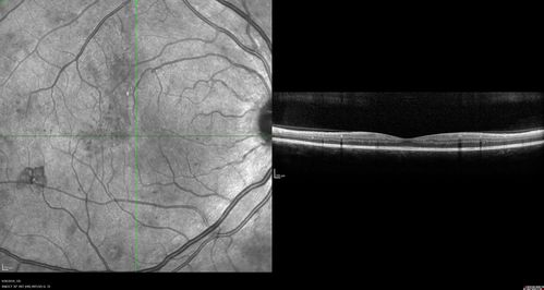 PDR NVD left eye and NVE right eye
41 year old diabetic woman with PDR in both eyes.  High risk in the left eye.  She had PRP, Avastin, and vitrectomy x 2 in the left eye with final vision of 20/25.  The right eye had eventually PRP laser
