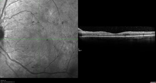 PDR NVD left eye and NVE right eye
41 year old diabetic woman with PDR in both eyes.  High risk in the left eye.  She had PRP, Avastin, and vitrectomy x 2 in the left eye with final vision of 20/25.  The right eye had eventually PRP laser

