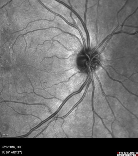 PDR NVD left eye and NVE right eye
41 year old diabetic woman with PDR in both eyes.  High risk in the left eye.  She had PRP, Avastin, and vitrectomy x 2 in the left eye with final vision of 20/25.  The right eye had eventually PRP laser
