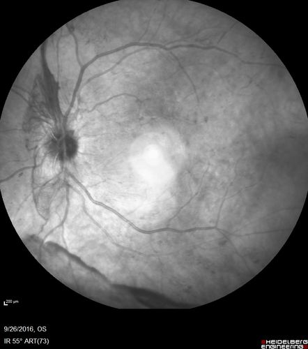 PDR NVD left eye and NVE right eye
41 year old diabetic woman with PDR in both eyes.  High risk in the left eye.  She had PRP, Avastin, and vitrectomy x 2 in the left eye with final vision of 20/25.  The right eye had eventually PRP laser
