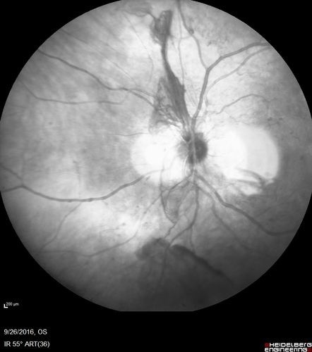 PDR NVD left eye and NVE right eye
41 year old diabetic woman with PDR in both eyes.  High risk in the left eye.  She had PRP, Avastin, and vitrectomy x 2 in the left eye with final vision of 20/25.  The right eye had eventually PRP laser
