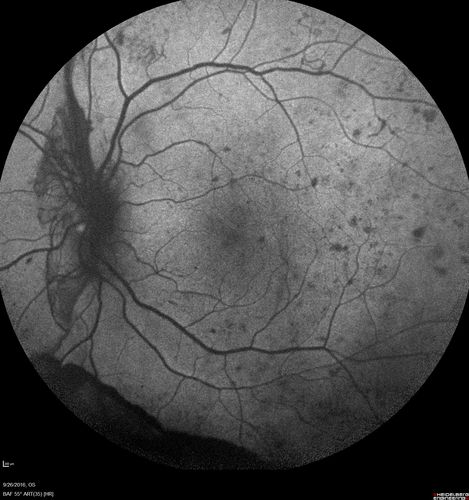 PDR NVD left eye and NVE right eye
41 year old diabetic woman with PDR in both eyes.  High risk in the left eye.  She had PRP, Avastin, and vitrectomy x 2 in the left eye with final vision of 20/25.  The right eye had eventually PRP laser
