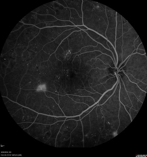 PDR NVD left eye and NVE right eye
41 year old diabetic woman with PDR in both eyes.  High risk in the left eye.  She had PRP, Avastin, and vitrectomy x 2 in the left eye with final vision of 20/25.  The right eye had eventually PRP laser
