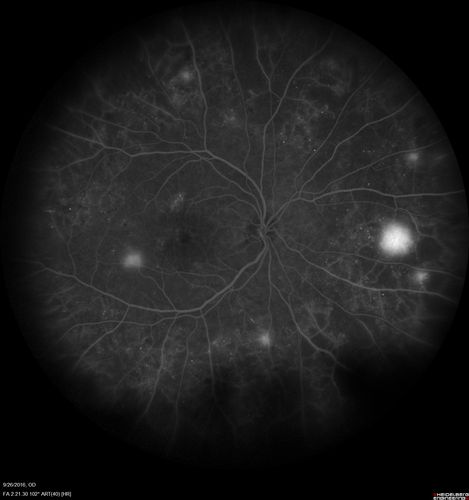 PDR NVD left eye and NVE right eye
41 year old diabetic woman with PDR in both eyes.  High risk in the left eye.  She had PRP, Avastin, and vitrectomy x 2 in the left eye with final vision of 20/25.  The right eye had eventually PRP laser
