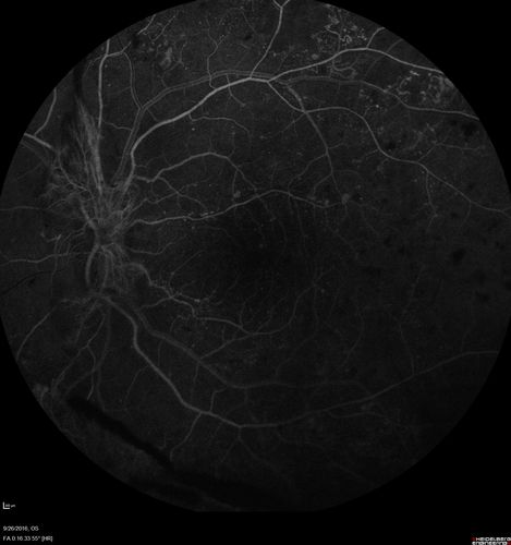 PDR NVD left eye and NVE right eye
41 year old diabetic woman with PDR in both eyes.  High risk in the left eye.  She had PRP, Avastin, and vitrectomy x 2 in the left eye with final vision of 20/25.  The right eye had eventually PRP laser
