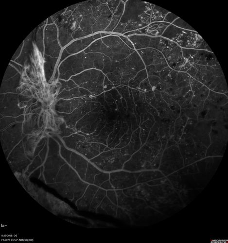 PDR NVD left eye and NVE right eye
41 year old diabetic woman with PDR in both eyes.  High risk in the left eye.  She had PRP, Avastin, and vitrectomy x 2 in the left eye with final vision of 20/25.  The right eye had eventually PRP laser
