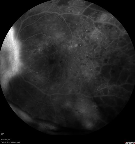 PDR NVD left eye and NVE right eye
41 year old diabetic woman with PDR in both eyes.  High risk in the left eye.  She had PRP, Avastin, and vitrectomy x 2 in the left eye with final vision of 20/25.  The right eye had eventually PRP laser
