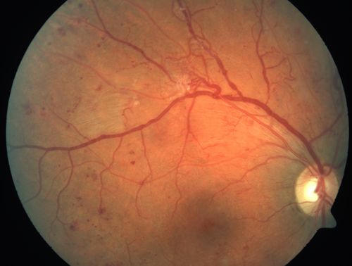 Proliferative Diabetic Retinopathy - Moderate - mild NVD with NVE 
Venous beading, vascular loops and NVE are visible on photos
