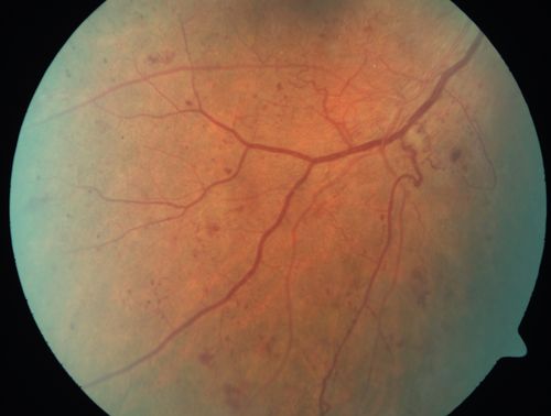 Proliferative Diabetic Retinopathy - Moderate - mild NVD with NVE 
Venous beading, vascular loops and NVE are visible on photos
