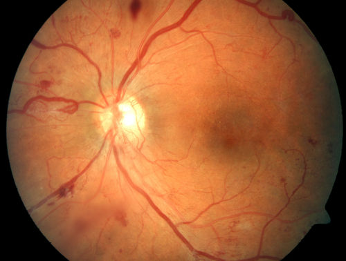 Proliferative Diabetic Retinopathy - Moderate - mild NVD with NVE 
Venous beading, vascular loops and NVE are visible on photos
