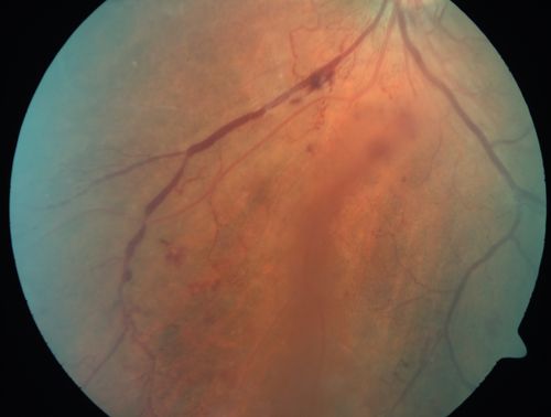 Proliferative Diabetic Retinopathy - Moderate - mild NVD with NVE 
Venous beading, vascular loops and NVE are visible on photos
