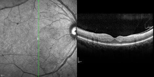 Proliferative Diabetic Retinopathy - Moderate - mild NVD with NVE 
SD OCT shows no significant macular edema
