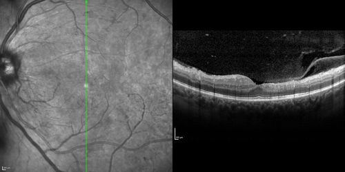 Proliferative Diabetic Retinopathy - Moderate - mild NVD with NVE 
SD OCT shows no significant macular edema
