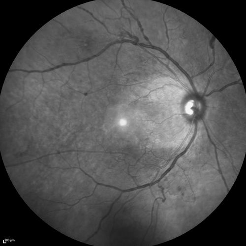 Proliferative Diabetic Retinopathy - Moderate - mild NVD with NVE 
IR reflectance
