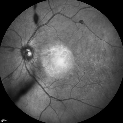 Proliferative Diabetic Retinopathy - Moderate - mild NVD with NVE 
IR reflectance

