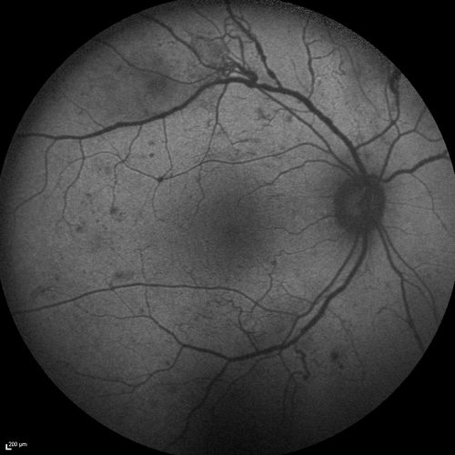 Proliferative Diabetic Retinopathy - Moderate - mild NVD with NVE 
FAF
