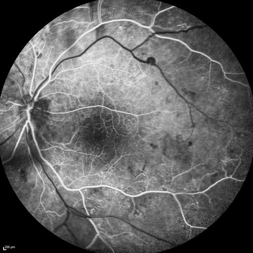 Proliferative Diabetic Retinopathy - Moderate - mild NVD with NVE 
FA shows leakage from neovascularization and dark areas in periphery from non-perfusion

