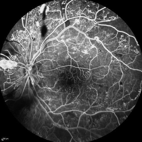 Proliferative Diabetic Retinopathy - Moderate - mild NVD with NVE 
FA shows leakage from neovascularization and dark areas in periphery from non-perfusion
