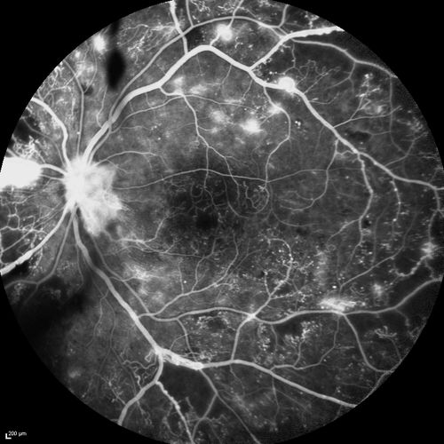 Proliferative Diabetic Retinopathy - Moderate - mild NVD with NVE 
FA shows leakage from neovascularization and dark areas in periphery from non-perfusion
