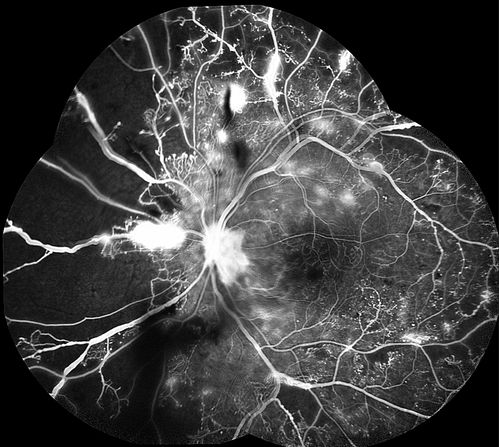 Proliferative Diabetic Retinopathy - Moderate - mild NVD with NVE 
FA shows leakage from neovascularization and dark areas in periphery from non-perfusion
