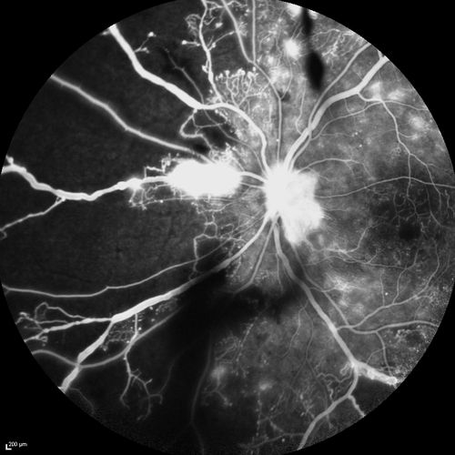 Proliferative Diabetic Retinopathy - Moderate - mild NVD with NVE 
FA shows leakage from neovascularization and dark areas in periphery from non-perfusion
