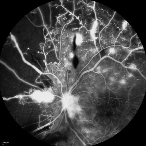 Proliferative Diabetic Retinopathy - Moderate - mild NVD with NVE 
FA shows leakage from neovascularization and dark areas in periphery from non-perfusion
