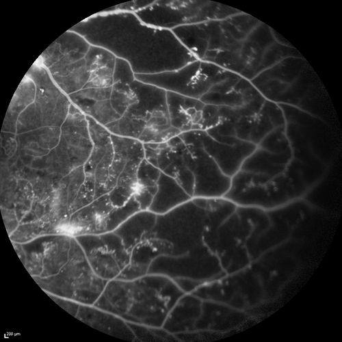 Proliferative Diabetic Retinopathy - Moderate - mild NVD with NVE 
FA shows leakage from neovascularization and dark areas in periphery from non-perfusion
