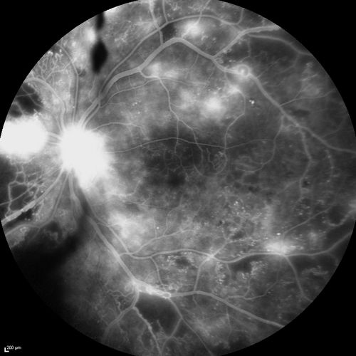 Proliferative Diabetic Retinopathy - Moderate - mild NVD with NVE 
FA shows leakage from neovascularization and dark areas in periphery from non-perfusion
