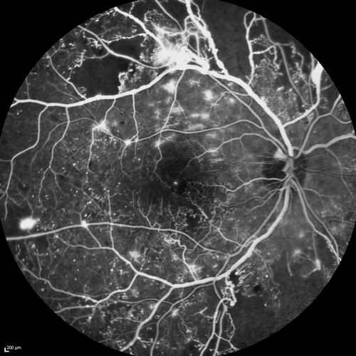 Proliferative Diabetic Retinopathy - Moderate - mild NVD with NVE 
FA shows leakage from neovascularization and dark areas in periphery from non-perfusion

