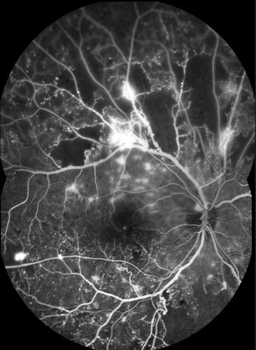 Proliferative Diabetic Retinopathy - Moderate - mild NVD with NVE 
FA shows leakage from neovascularization and dark areas in periphery from non-perfusion
