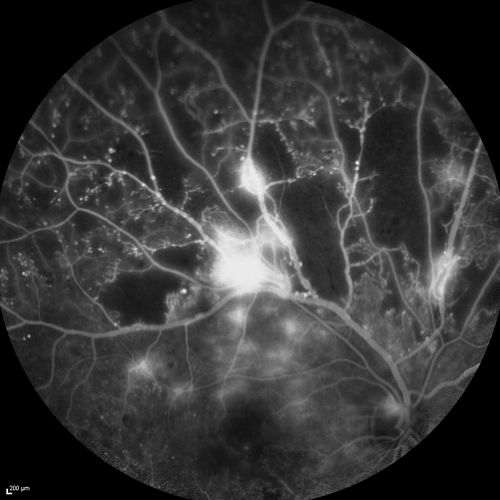 Proliferative Diabetic Retinopathy - Moderate - mild NVD with NVE 
FA shows leakage from neovascularization and dark areas in periphery from non-perfusion
